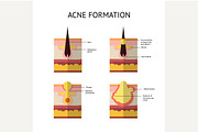 Formation of skin acne or pimple.